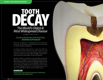 Anatomical cross-section of tooth decay showing internal damage and disease progression in dental tissue.