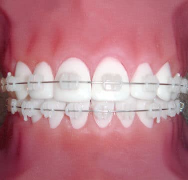 Close-up of teeth with metal braces and brackets showing orthodontic treatment alignment.