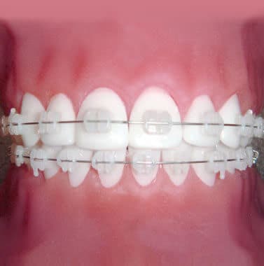Close-up view of teeth with metal braces and wire against pink gum background.
