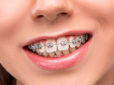 Close-up of smiling person wearing metal braces on upper and lower teeth.