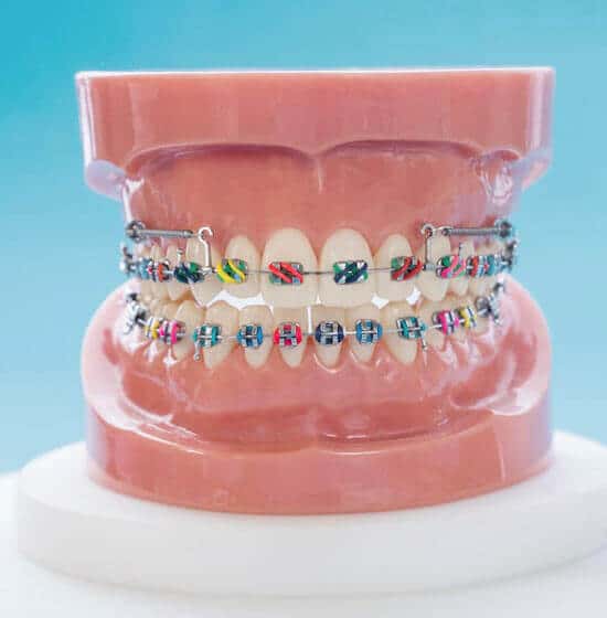 Dental model displaying two rows of colorful braces on teeth against blue background.