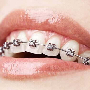 Close-up of teeth with metal braces showing orthodontic treatment progress on upper teeth.
