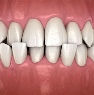 Digital dental model showing misaligned teeth with gaps before orthodontic treatment.