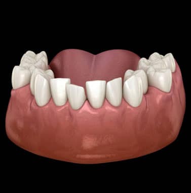 3D dental model showing upper teeth and gums with white tooth crowns on pink gum tissue.
