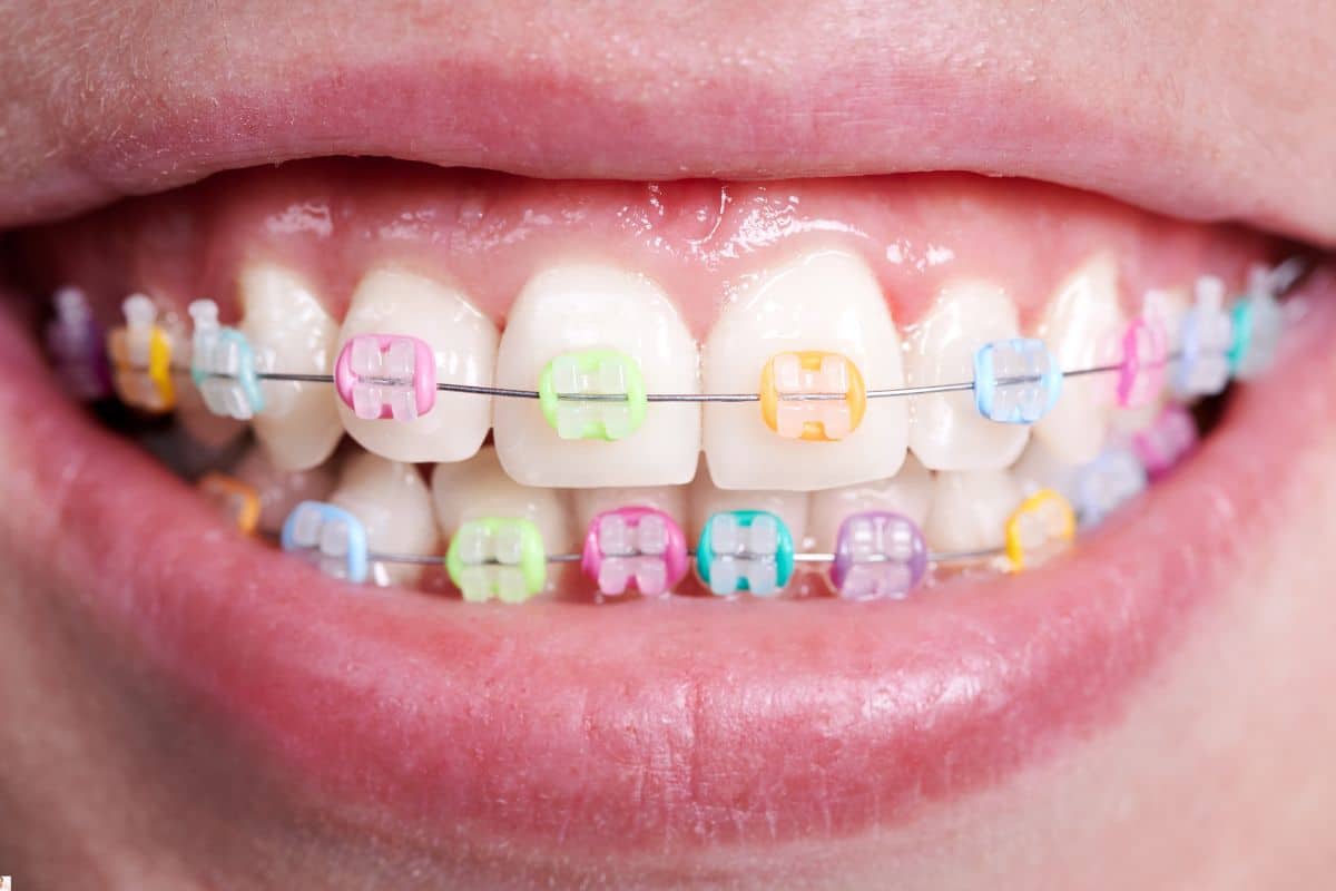 Ceramic Braces for Teens