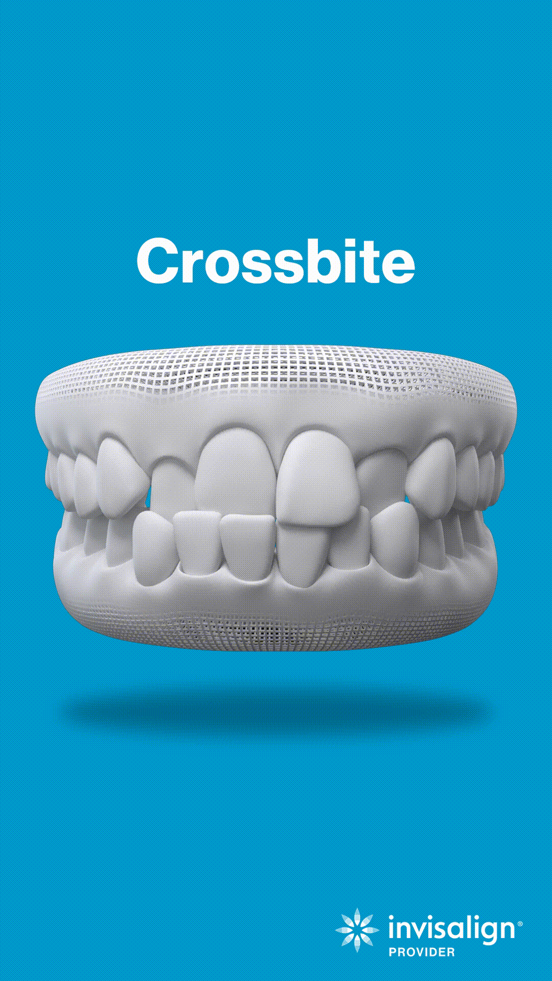 Crossbite dental model showing misaligned upper and lower teeth on blue background.
