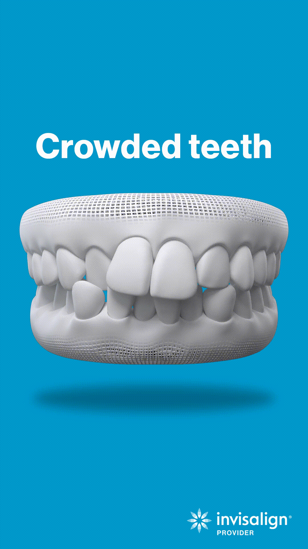 3D dental model displaying crowded teeth condition on blue background with Invisalign branding