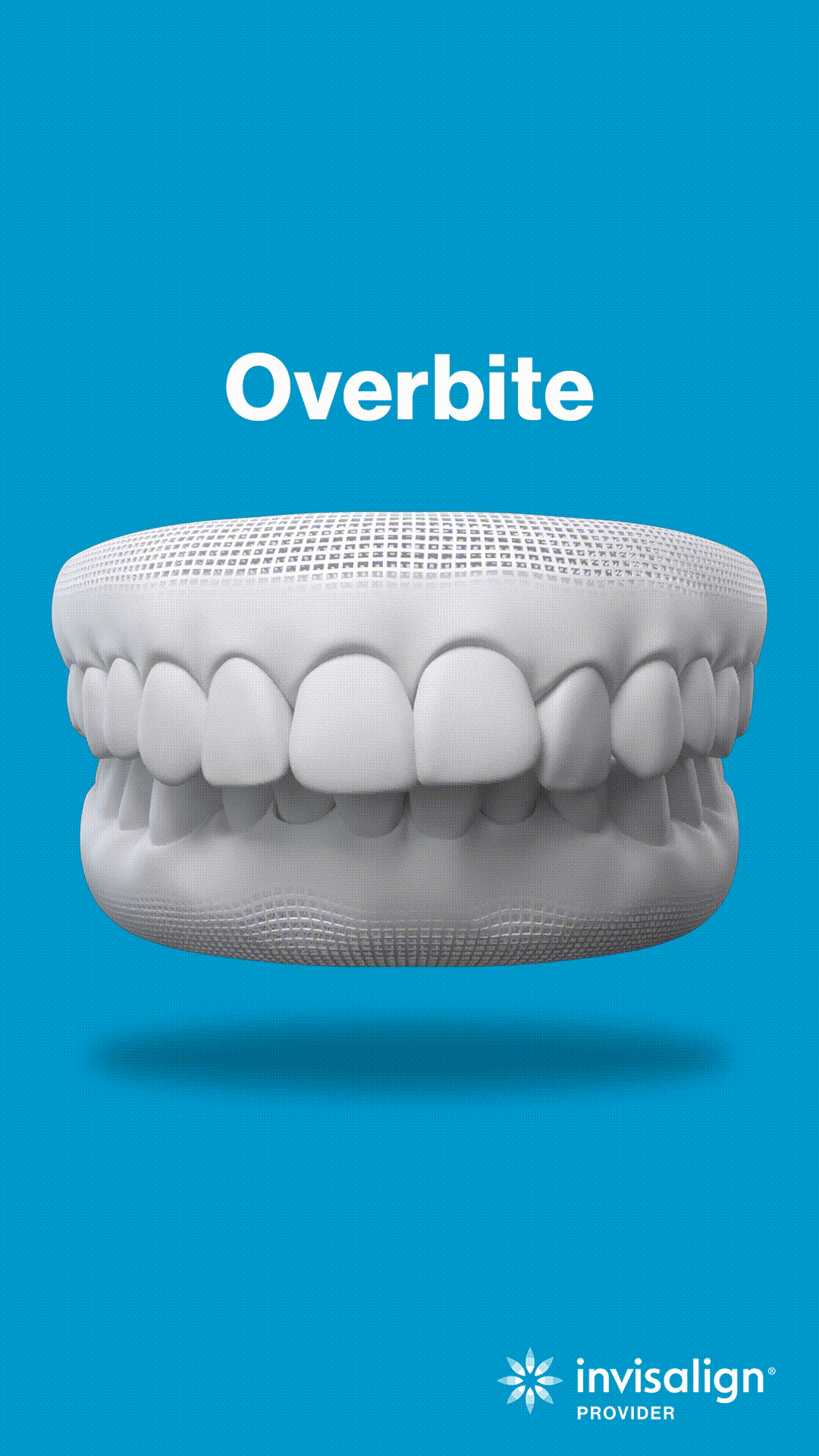 3D dental model showing overbite malocclusion against blue background with Invisalign branding