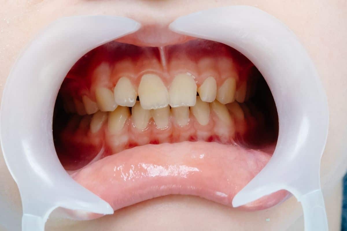 Featured image for “What Causes Gaps Between Teeth? Understanding Diastema and Treatment Options”