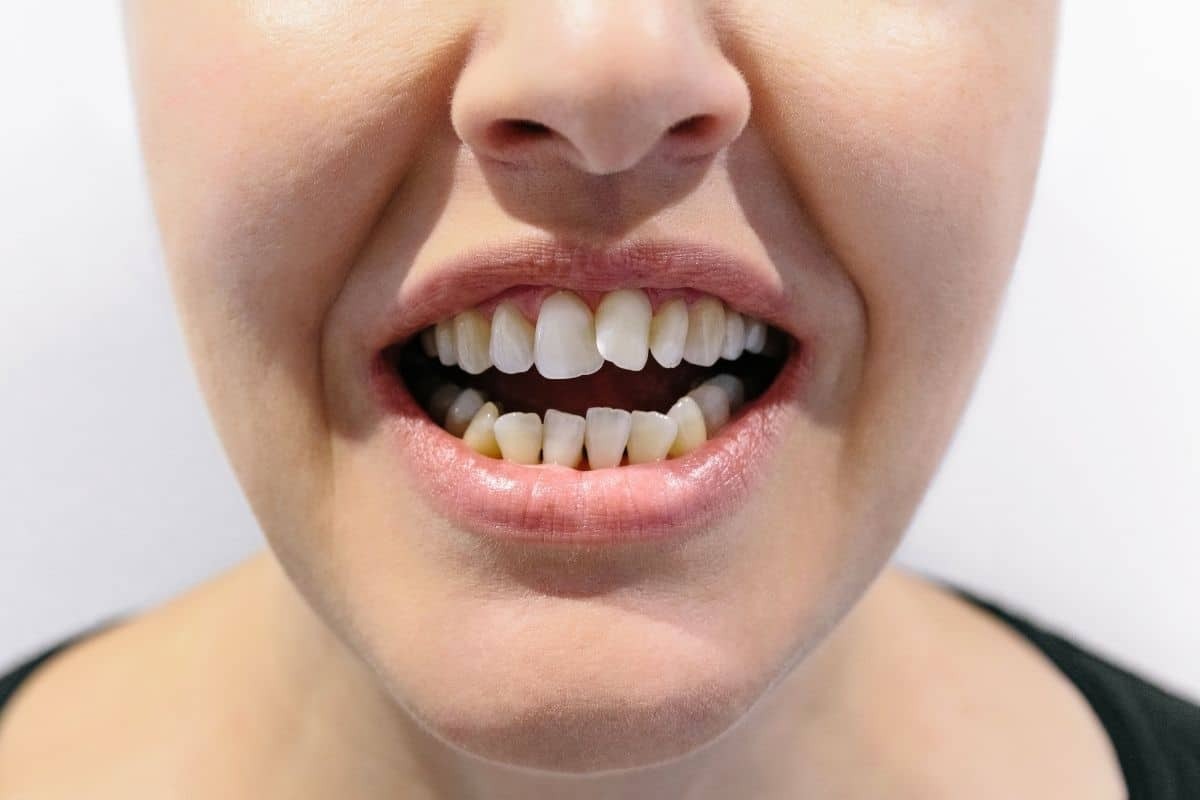 Close-up of misaligned teeth showing crowding and spacing issues in a patient's smile.