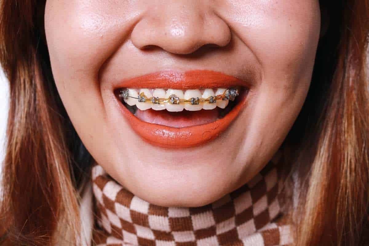 Close-up of a smiling patient with metal braces displaying proper dental alignment and oral health.