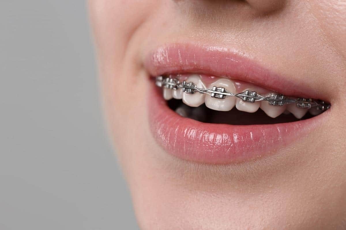 Close-up of a patient's smile showing metal braces on upper teeth during orthodontic treatment.