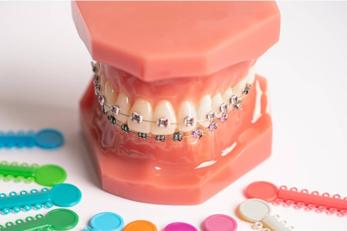 Featured image for “What to Eat During Orthodontic Treatment: Soft Foods, Safe Choices, and Recovery Tips”